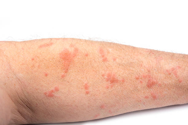 istock Skin disease rash on a man arm 1222618940
