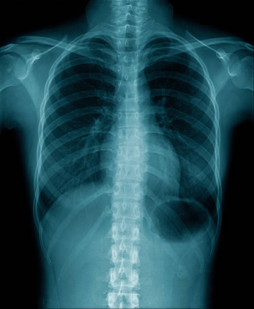istock chest x-ray show inside of lung 1222669491