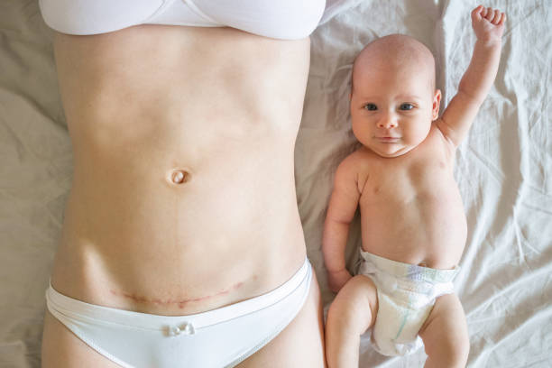 primer plano del vientre de la mujer con una cicatriz de una cesárea y su bebé cerca - cesarean fotografías e imágenes de stock