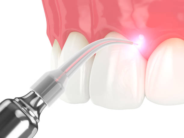 rendering 3d del laser a diodi dentali utilizzato per il trattamento delle gengive - medical supplies scalpel surgery equipment foto e immagini stock