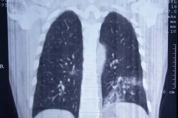 Photo of X-ray of pneumonia-affected lungs. CT scan.