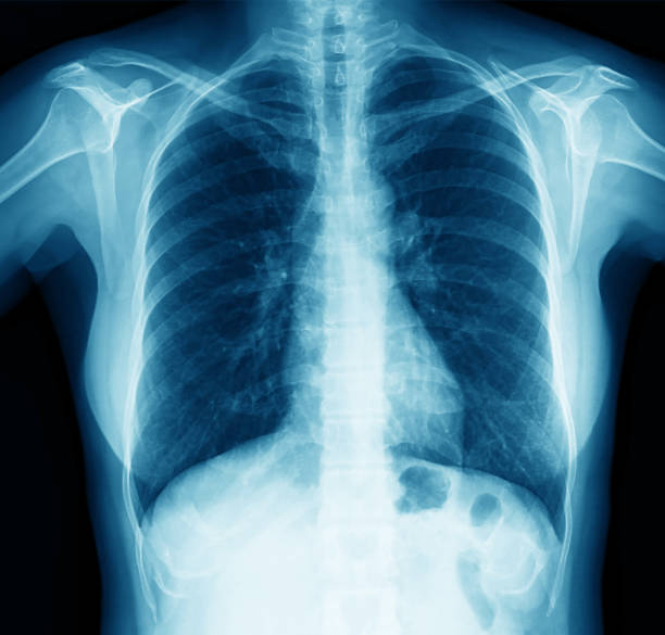 istock Chest X-ray Image of Women 1222844121