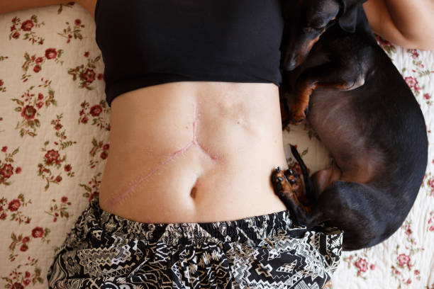 Woman leaning dow showing her liver transplant scars Woman leaning dow showing her liver transplant scars . liver organ stock pictures, royalty-free photos & images