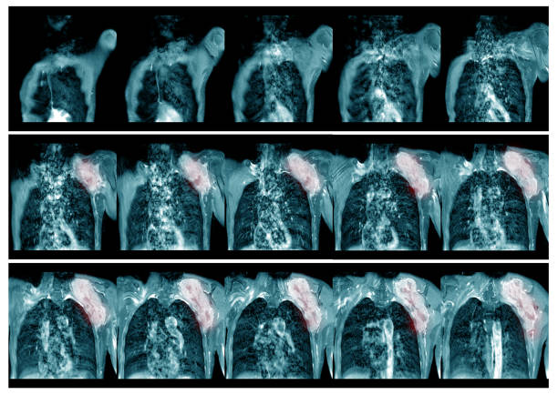 istock MRI Lt.shoulderHistory:Case Lt. shoulder mass PE mass 20x20x20 cm Lt.scapula . 1222909727