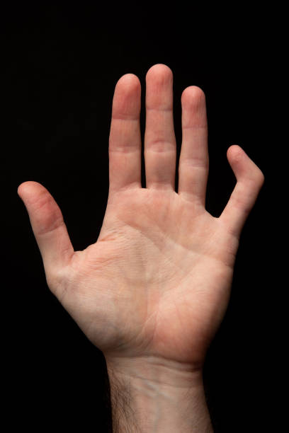 istock Palm of a hand with a broken finger bone 1222963340