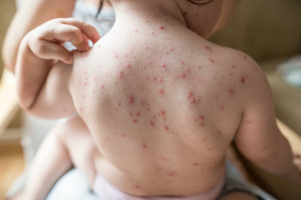 bambino graffiare eruzione cutanea varicella sulla spalla - chickenpox skin condition baby illness foto e immagini stock