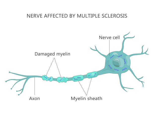 Multiple Sclerosis Failure Myelin Cells Multiple sclerosis (MS) - autoimmune disease of the nerves. Failure of the myelin-producing cells. medulla stock illustrations