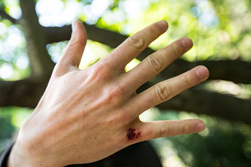 Close-up of Young Adult Man's Injured Knuckle.