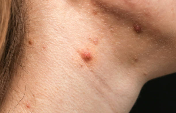 istock Scars and wounds on the neck after acne. Woman's oily skin with problems acne. 1223060883
