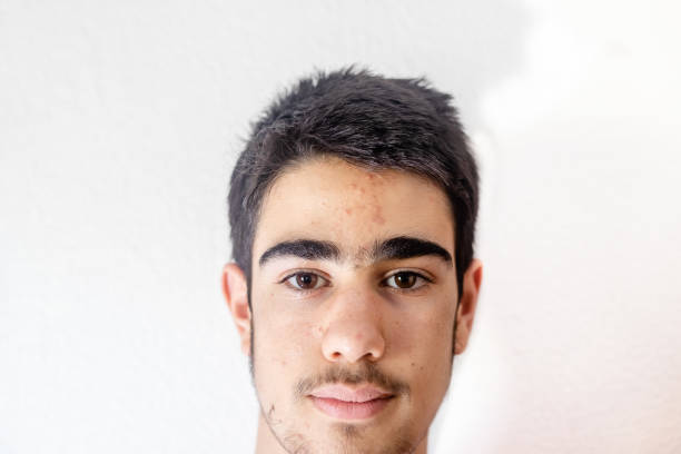 istock Teenage boy with acne problem onwhite background. 1223069923
