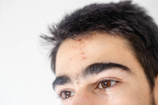 istock Teenage boy with acne problem onwhite background. 1223069925