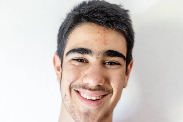 istock Teenage boy with acne problem onwhite background. 1223069926