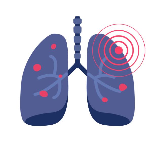 1,800개 이상의 Lung Cancer 스톡 일러스트, Royalty-Free 벡터 그래픽 및 클립 아트 - iStock