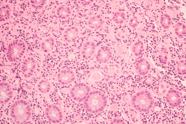 View in microscopic of ductal cell carcinoma, adenonocarcinoma from human breast cancer, tissue section by H and E stain.Pathology diagnosis.Medical concept. Under microscope, magnification 600X View in microscopic of ductal cell carcinoma, adenonocarcinoma from human breast cancer, tissue section by H and E stain.Pathology diagnosis.Medical concept. Under microscope, magnification 600X adenocarcinoma photos stock pictures, royalty-free photos & images