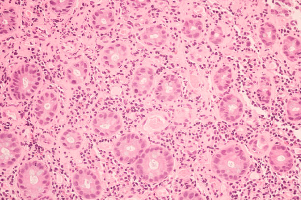 vista em microscópico de carcinoma de células ductais, adenonocarcinoma do câncer de mama humano, seção de tecido por mancha h e e. diagnóstico patológico. conceito médico. sob microscópio, ampliação 600x - adenocarcinoma - fotografias e filmes do acervo