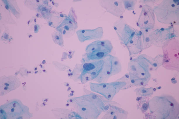 vue dans le microscopique des cellules humaines anormales de col de l’utérus. cellules épithélium squamous. cellules épithéliales superficielles et intermédiaires. département de laboratoire de cytologie et de pathologie. agrandissement 600 x - intermediate photos et images de collection