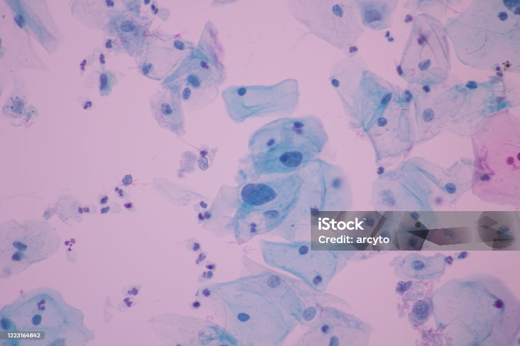 View in microscopic of Abnormal human cervix cells.Squamous epithelium cells.Superficial and intermediate epithelial cells.Cytology and pathology laboratory department.Magnification 600 X Human Papilloma Virus Stock Photo