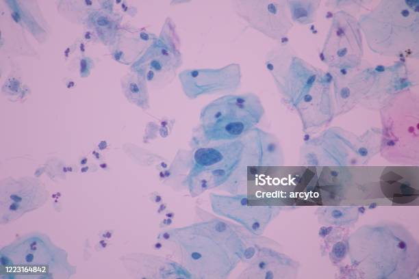 View In Microscopic Of Abnormal Human Cervix Cellssquamous Epithelium Cellssuperficial And Intermediate Epithelial Cellscytology And Pathology Laboratory Departmentmagnification 600 X Stock Photo - Download Image Now