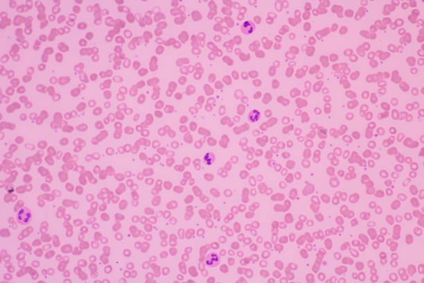 Human blood smear view in microscopy.Complete blood count for treatment. Polymorphonuclear cells(PMNs), eosinophils and lymphocytes.Hematology laboratory.Medical background.Magnification 600 x. stock photo
