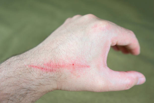 istock two scratch on man crossed arms closeup 1223171465