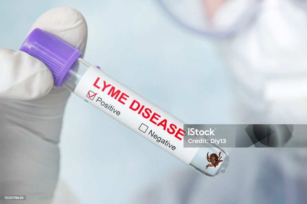 Lyme Disease Label On A Test Tube In The Hands Of A ...