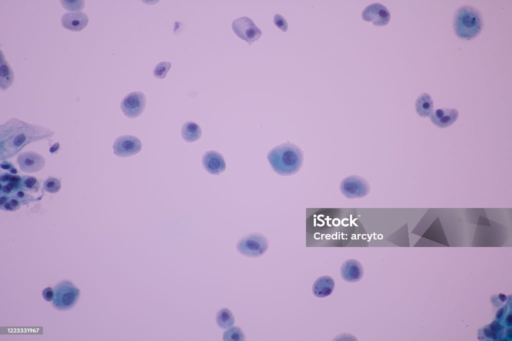 View in microscopic of normal human cervix cells.Squamous epithelium cells.Parabasal and basal epithelial cells.Cytology and pathology laboratory department.Magnification 600 X Cervix Stock Photo
