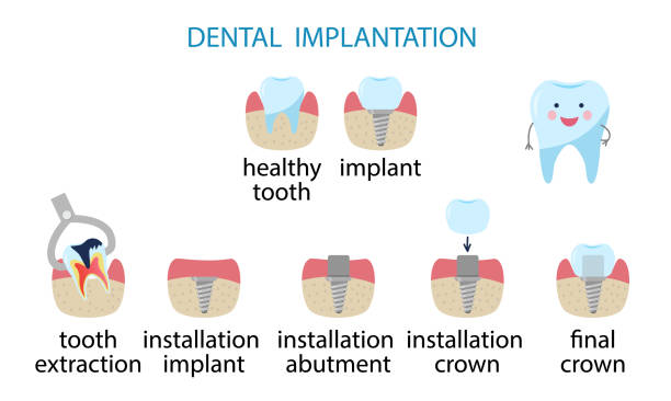 infographics dental implantation. Stages of implant installation. infographics dental implantation. Stages of implant installation. Happy healthy tooth. Vector Illustration isolated on white. cute cartoon dental implants stock illustrations