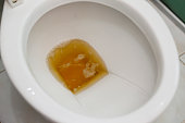 toilet bowl containing dark urine