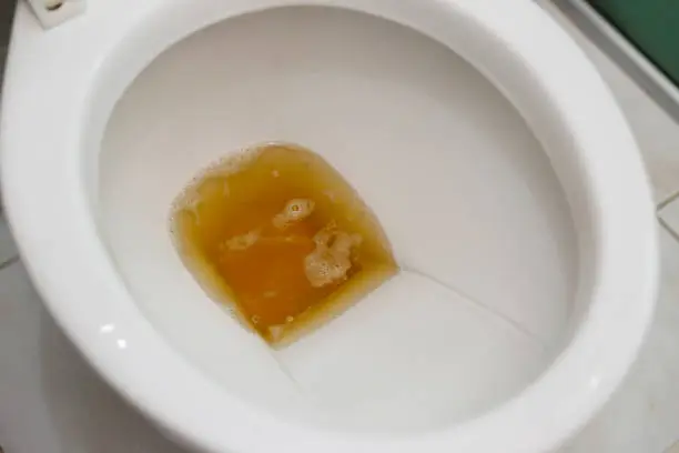 Photo of toilet bowl containing dark urine