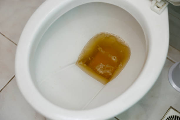 istock toilet bowl containing dark urine 1223416552