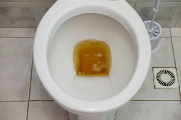istock toilet bowl containing dark urine 1223416558