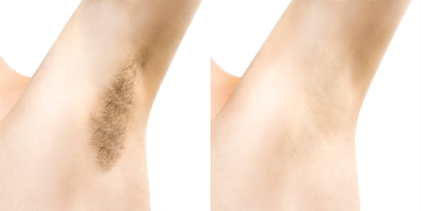 istock Hair under the armpits. Depilation. 1223492435