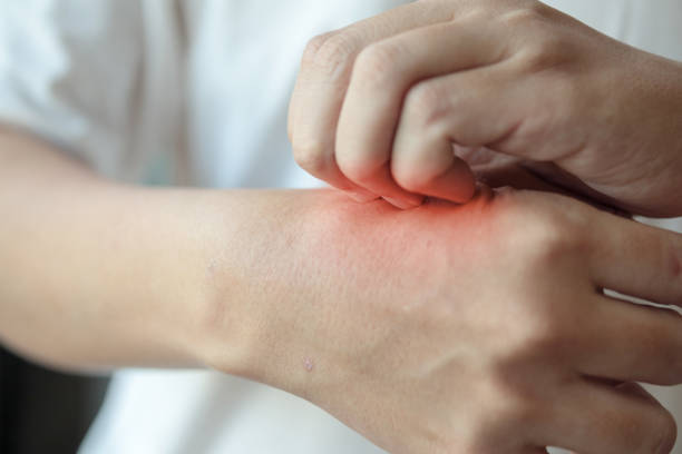 istock man itching and scratching on hand from insect bite or itchy dry skin eczema dermatitis 1223525028