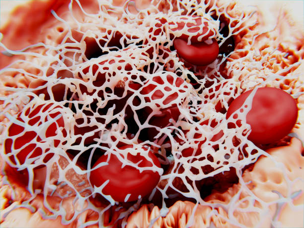 Blood clot (thrombus). Erythrocytes (red blood cells) are trapped within a fibrin mesh. Erythrocytes (red blood cells) are trapped within a fibrin mesh. blood clot photos stock pictures, royalty-free photos & images
