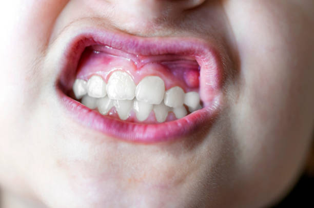 istock Little girl's teeth 1223859836