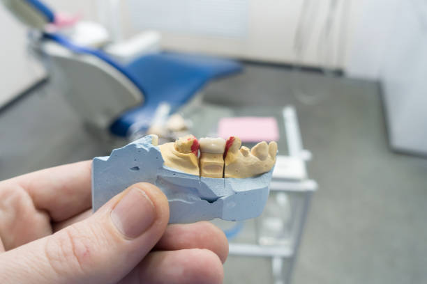 istock dental ceramic-metal crowns on a plaster model 1223868073