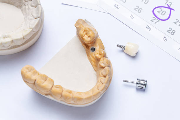 a dental implant with a ceramic crown and a dental instrument lie on a white background, in the upper right calendar indicating a visit to the dentist. dentist appointment concept a dental implant with a ceramic crown and a dental instrument lie on a white background, in the upper right calendar indicating a visit to the dentist. dentist appointment concept zahnarzt stock pictures, royalty-free photos & images