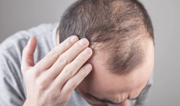 Caucasian man checking his hair. Hair loss problem stock photo