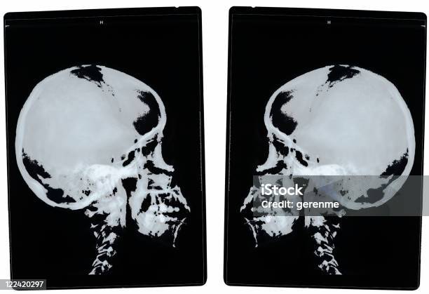 Xray Of Head Stock Photo - Download Image Now - Color Image, Data, Diagnostic Medical Tool