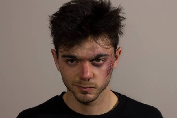 istock Defiant injured young man looking at the camera 1224378283