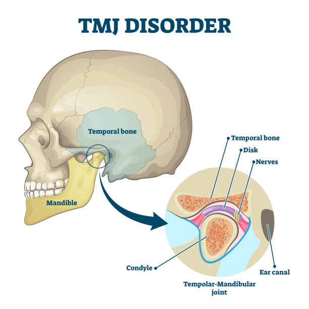 TMJ disorder vector illustration. Labeled jaw condition educational scheme. vector art illustration