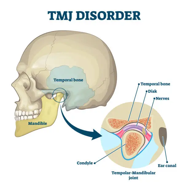 Vector illustration of TMJ disorder vector illustration. Labeled jaw condition educational scheme.