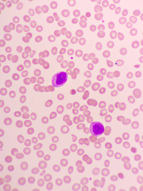 istock Acute promyelocytic leukemia cells or APL 1224631177