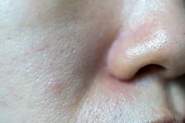 Acne blackheads on skin of nose and spot melasma pigmentation on facial Asian woman.