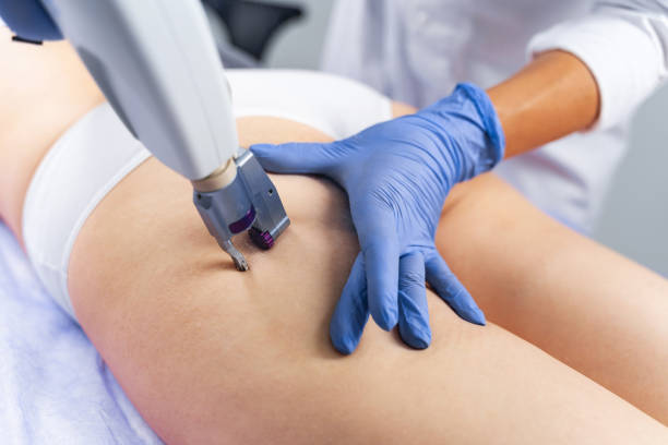 istock Woman being treated for cellulite in a spa salon 1224799124