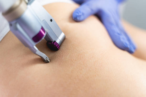istock Caucasian female patient undergoing an anti-cellulite treatment 1224799127