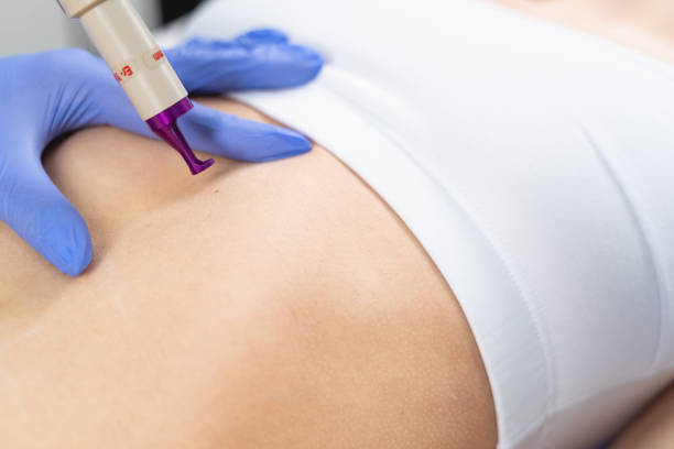 istock Female patient getting a small nevus removed 1224799139