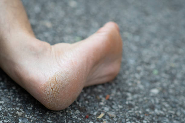 istock cracked heels in men on asphalt road 1224829577