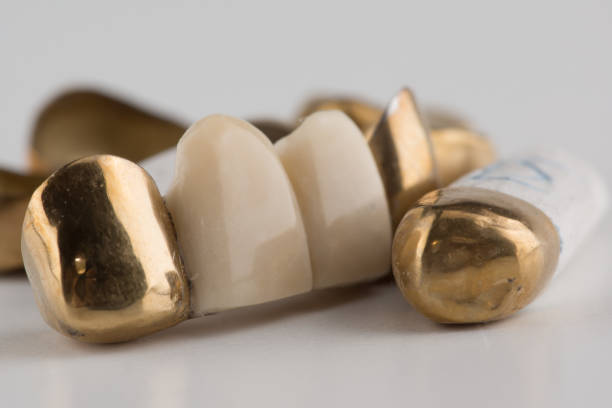 istock stamped brazed dental bridges 1224858601