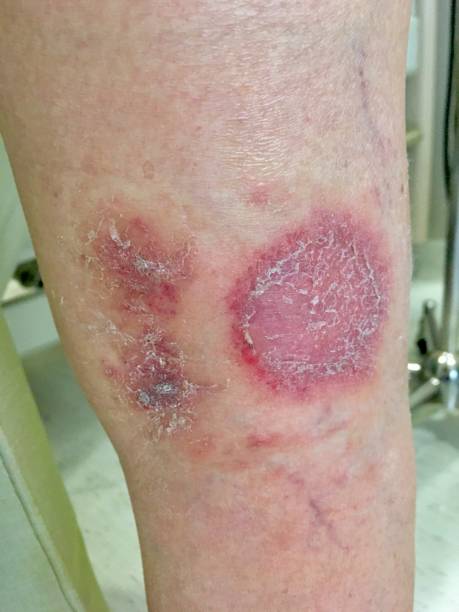 istock Skin lesions on leg 1224961014
